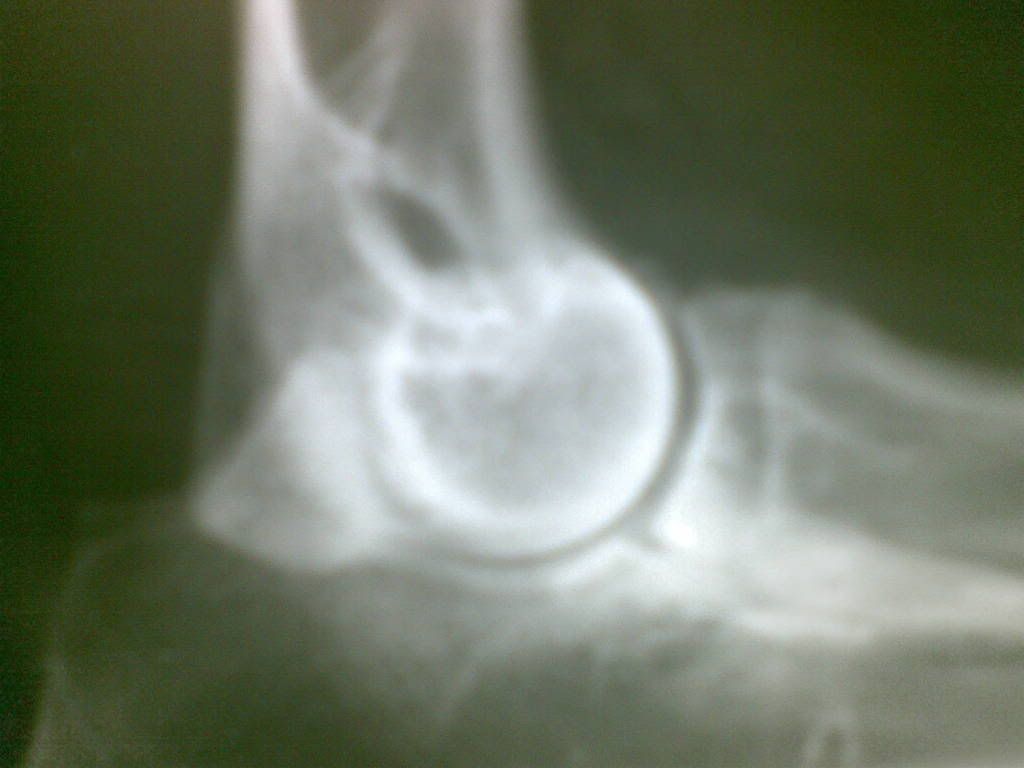 Left Elbow