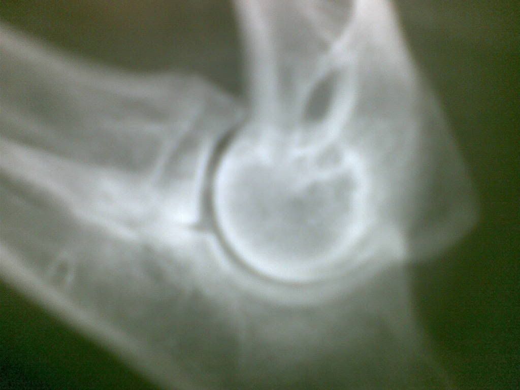 Right Elbow