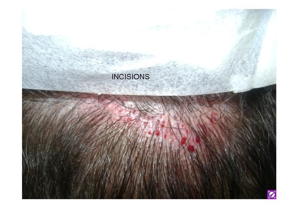 incisions.jpg